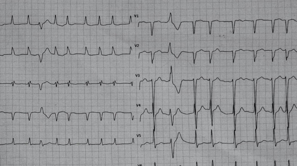 Il cuore lento dei sub replicato nei ratti, per studiare aritmie